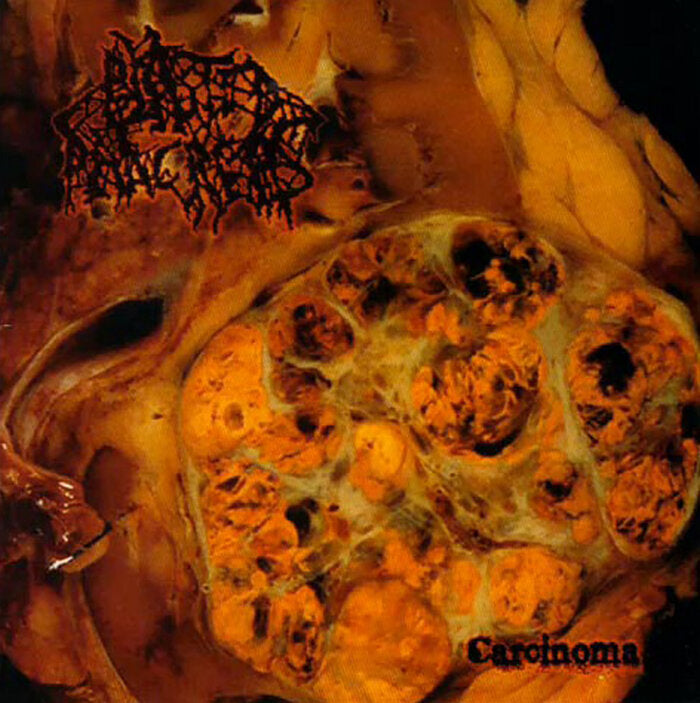 Blasted Pancreas- Carcinoma CD Gore House Prod.