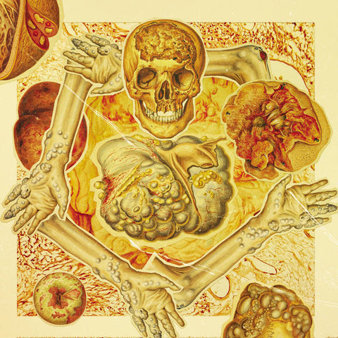 G.I.S.T.- A Postmortem Diagnosis Of Malignany Submucosal Tumors CD on Lymphatic Sexual Orgy Rec.